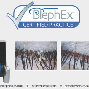 THIẾT BỊ ĐIỀU TRỊ VIÊM MÍ MẮT