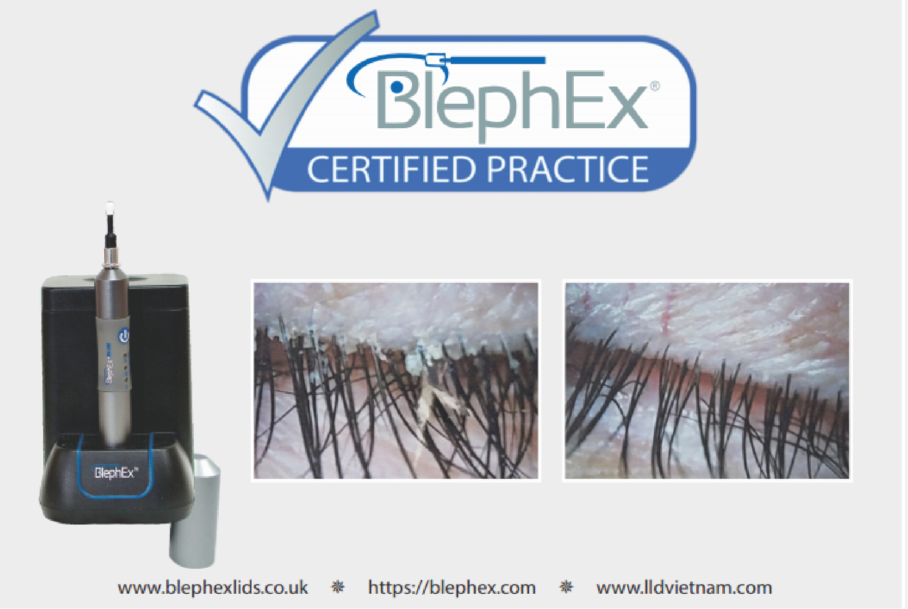 THIẾT BỊ ĐIỀU TRỊ VIÊM MÍ MẮT